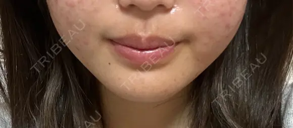 ボトックス（あご） / ボトックス（エラ・小顔） / ボトックス（口角） STELLA LUNNA CLINIC AFTER メイン用