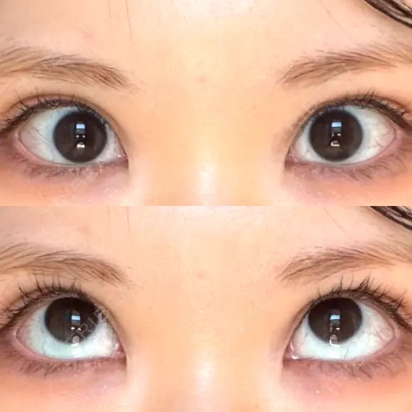 タレ目形成・グラマラスライン（切開） 形成外科と美容外科のクリニック池袋 AFTER メイン用