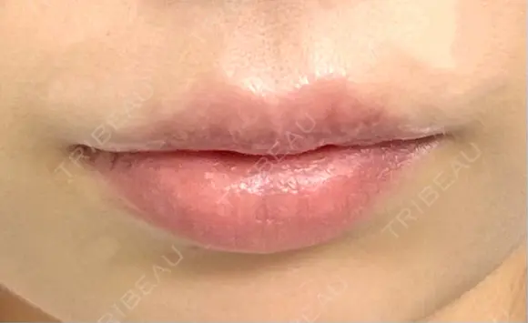 口唇縮小術 博多美容外科/美容皮膚科 ビラビューティークリニック DAY 28 メイン用