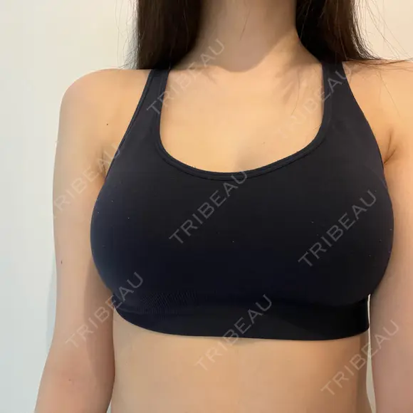 脂肪吸引（脚） / 豊胸（脂肪注入） Bloom Delight Clinic DAY 259 メイン用