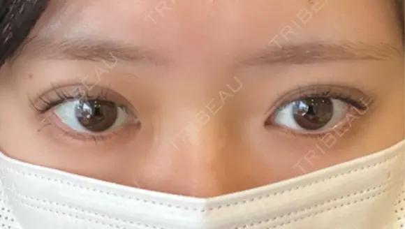 二重埋没 EMMA CLINIC（エマクリニック） DAY 6 メイン用