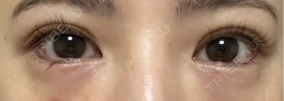 目尻切開 / タレ目形成・グラマラスライン（埋没） LOUIS CLINIC 二子玉川院【ルイクリニック】 DAY 7 メイン用