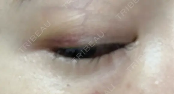 目尻切開 / タレ目形成・グラマラスライン（埋没） LOUIS CLINIC 二子玉川院【ルイクリニック】 DAY 7 メイン用