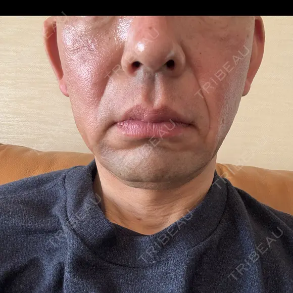 RF（高周波）たるみ治療 plume clinic DAY 0 メイン用