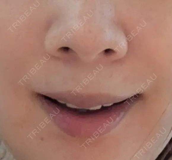 真皮移植 / 鼻翼基部形成（貴族手術） EMMO FACE CLINIC 東京三田院 DAY 4 メイン用