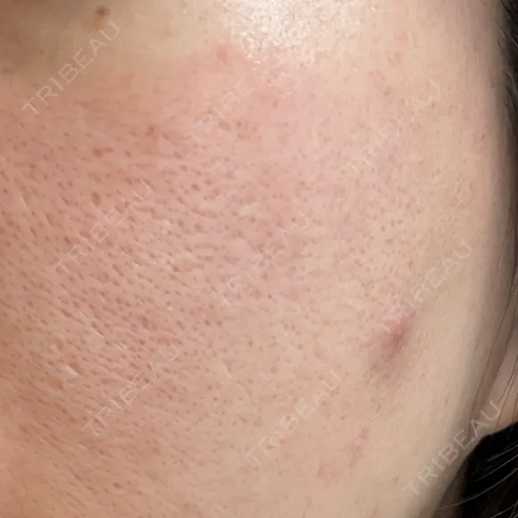 ポテンツァ 大美会クリニック 岡山院 DAY 1 メイン用