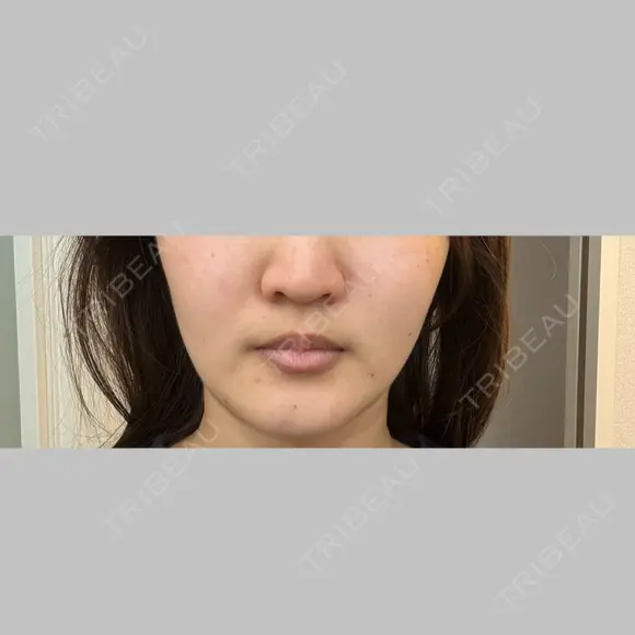 インモード ルラ美容クリニック 池袋院 AFTER メイン用