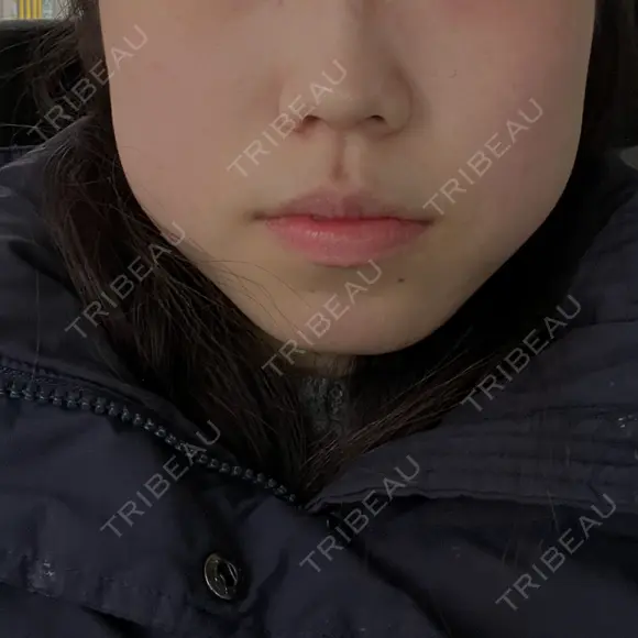 ボトックス（エラ・小顔） ルラ美容クリニック 京都院 DAY 2 メイン用