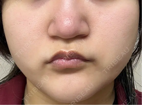 医療脱毛（顔） 東京シルククリニック 東京神田院 DAY 1 メイン用