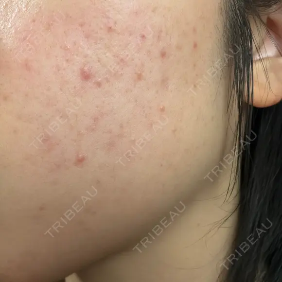 毛穴洗浄（ハイドラフェイシャルなど） / ルメッカ おおかみ美容のクリニック 新宿院 AFTER メイン用