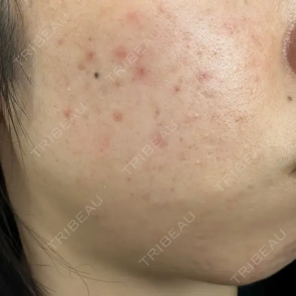 毛穴洗浄（ハイドラフェイシャルなど） / ルメッカ おおかみ美容のクリニック 新宿院 DAY 15 メイン用