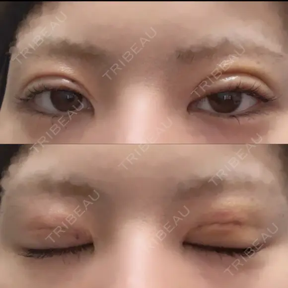 二重埋没 形成外科と美容外科のクリニック池袋 DAY 2 メイン用