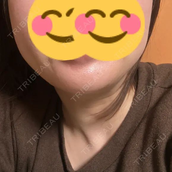 ボトックス（あご） / ボトックス（額） 湘南美容クリニック 名古屋駅本院 DAY 39 メイン用