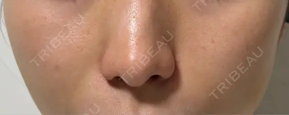 ヒアルロン酸注入（頬） Wi Clinic （ウィ クリニック）心斎橋院 DAY 4 メイン用