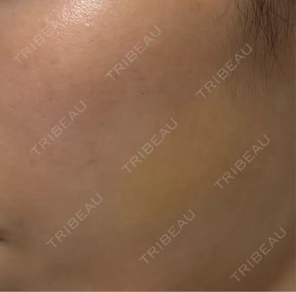 ヒアルロン酸注入（頬） Wi Clinic （ウィ クリニック）心斎橋院 DAY 4 メイン用