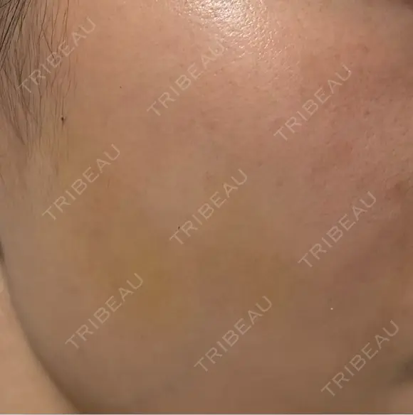 ヒアルロン酸注入（頬） Wi Clinic （ウィ クリニック）心斎橋院 DAY 4 メイン用