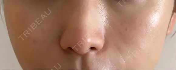 ヒアルロン酸注入（頬） Wi Clinic （ウィ クリニック）心斎橋院 DAY 8 メイン用