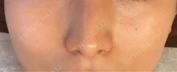 ヒアルロン酸注入（頬） Wi Clinic （ウィ クリニック）心斎橋院 DAY 15 メイン用