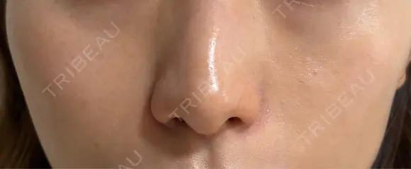 ヒアルロン酸注入（頬） Wi Clinic （ウィ クリニック）心斎橋院 DAY 92 メイン用