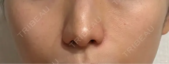 ヒアルロン酸注入（頬） Wi Clinic （ウィ クリニック）心斎橋院 DAY 153 メイン用