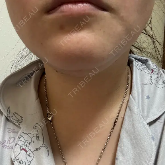 脂肪溶解注射（顔） ルラ美容クリニック 横浜院 DAY 2 メイン用