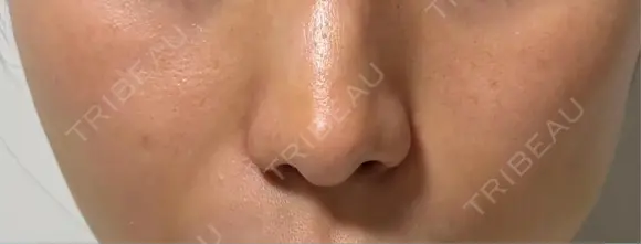 ヒアルロン酸注入（頬） Wi Clinic （ウィ クリニック）心斎橋院 DAY 5 メイン用