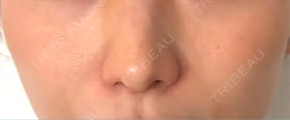 ヒアルロン酸注入（頬） Wi Clinic （ウィ クリニック）心斎橋院 AFTER メイン用