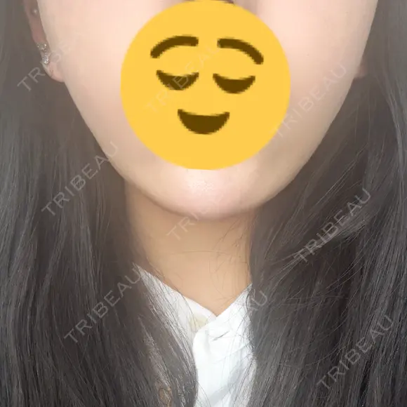 糸リフト / 脂肪吸引（顔） / ボトックス（エラ・小顔） Wing clinic 豊中駅前院 AFTER メイン用