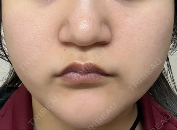 医療脱毛（顔） 東京シルククリニック 東京神田院 AFTER メイン用