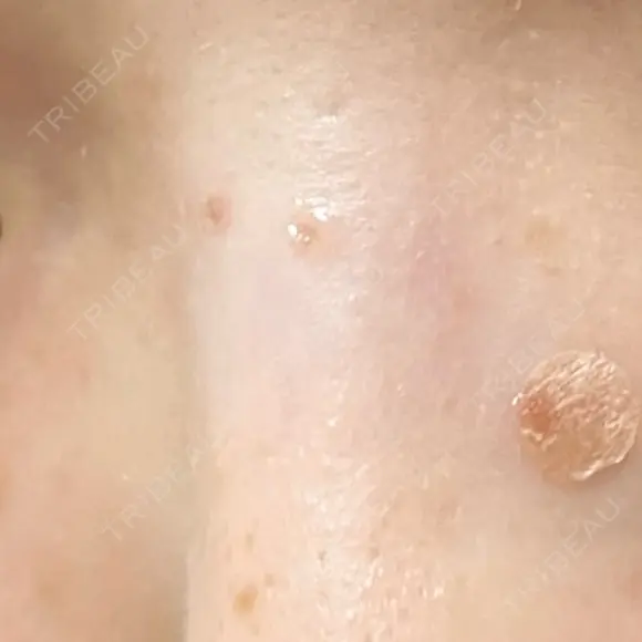 ほくろ・いぼ切除（肌） フローラクリニック DAY 6 メイン用