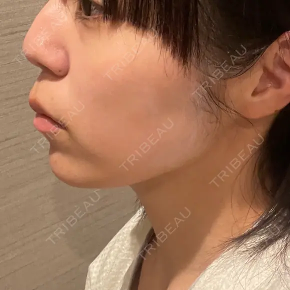 インモード TUNE CLINIC【チューンクリニック】 DAY 1 メイン用