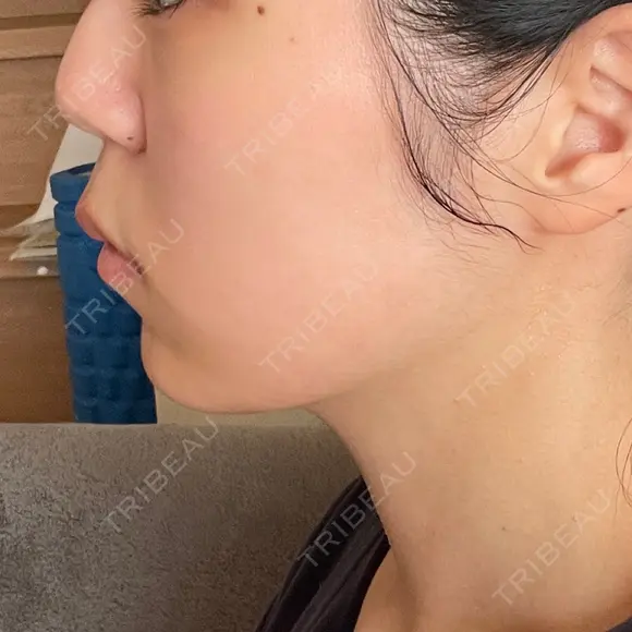 インモード TUNE CLINIC【チューンクリニック】 DAY 2 メイン用