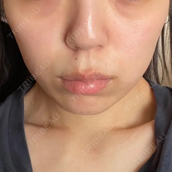 インモード TUNE CLINIC【チューンクリニック】 DAY 2 メイン用