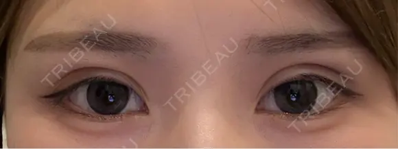 二重埋没 湘南美容クリニック 千葉センシティ院 AFTER メイン用