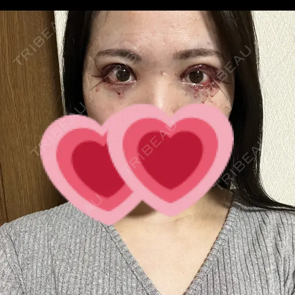 二重切開 / 眼瞼下垂（切開） / 目尻切開 / タレ目形成・グラマラスライン（切開） eクリニック 福岡院 DAY 0 メイン用