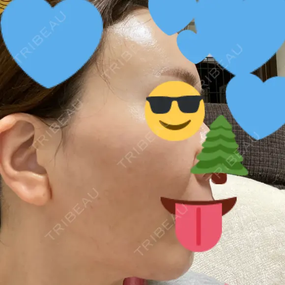 肌育注射（ジュベルックなど） / RF（高周波）たるみ治療 大美会クリニック 梅田院 DAY 65 メイン用