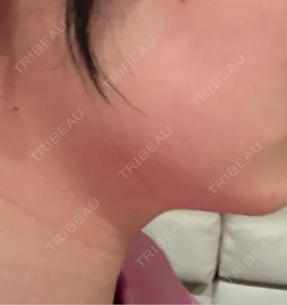 RF（高周波）たるみ治療 CIEL SKIN CLINIC（シエルスキンクリニック） AFTER メイン用