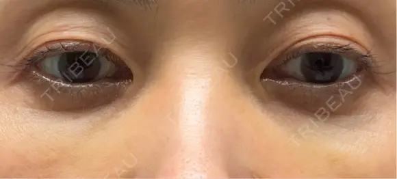 スネコス 札幌美容外科ネビュラクリニック DAY 13 メイン用