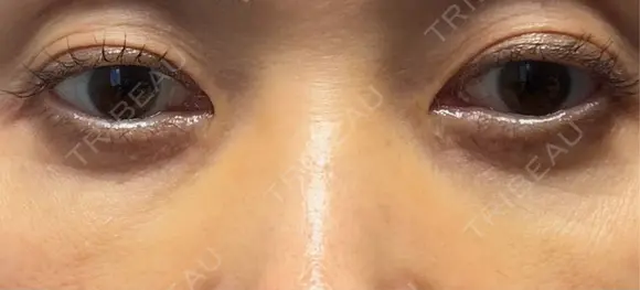 スネコス 札幌美容外科ネビュラクリニック DAY 12 メイン用