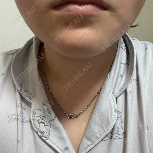 脂肪溶解注射（顔） ルラ美容クリニック 横浜院 DAY 3 メイン用