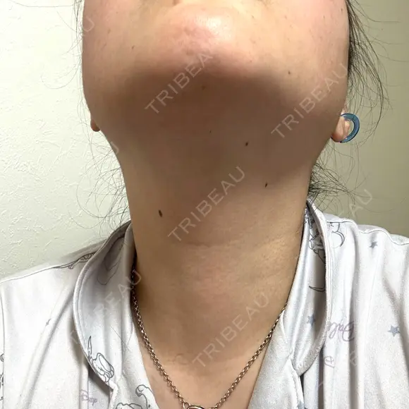 脂肪溶解注射（顔） ルラ美容クリニック 横浜院 DAY 3 メイン用