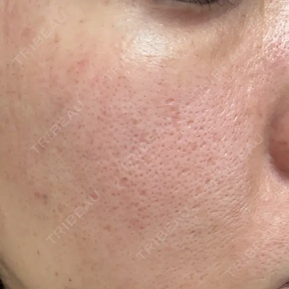 ポテンツァ 大美会クリニック 岡山院 DAY 2 メイン用