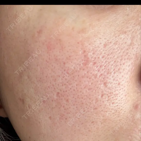 ポテンツァ 大美会クリニック 岡山院 DAY 3 メイン用