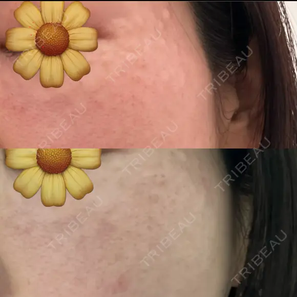スネコス Natural Skin Clinic 自由ヶ丘院 AFTER メイン用