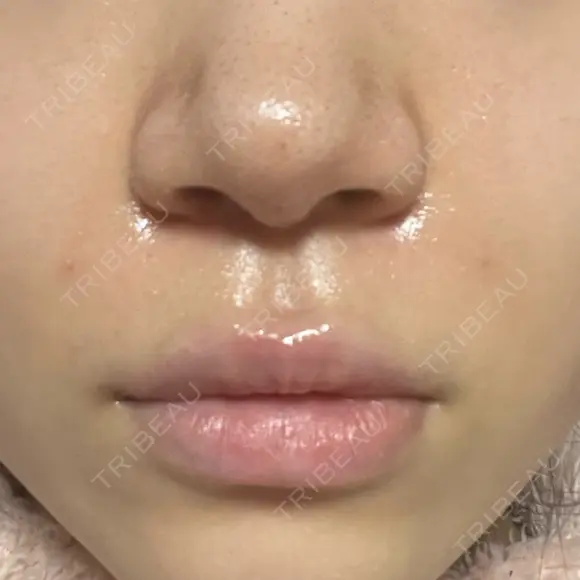 ボトックス（口角） / ヒアルロン酸注入（鼻翼基部） ルラ美容クリニック 大阪本院 DAY 1 メイン用