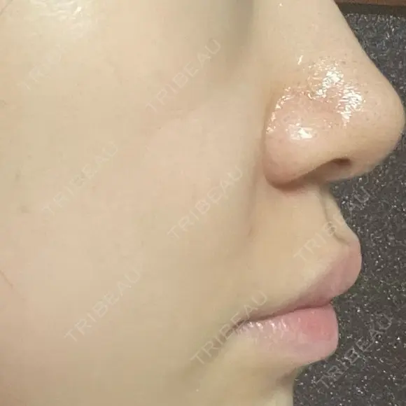 ボトックス（口角） / ヒアルロン酸注入（鼻翼基部） ルラ美容クリニック 大阪本院 DAY 1 メイン用