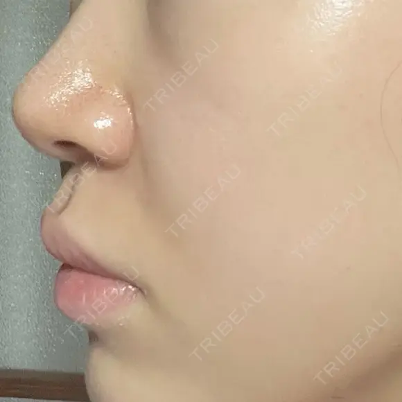 ボトックス（口角） / ヒアルロン酸注入（鼻翼基部） ルラ美容クリニック 大阪本院 DAY 1 メイン用