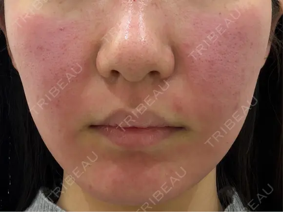 ポテンツァ 渋谷美容外科クリニック 横浜院 DAY 0 メイン用