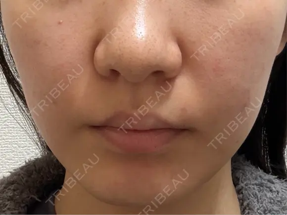 ポテンツァ 渋谷美容外科クリニック 横浜院 AFTER メイン用