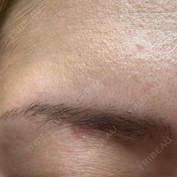 ほくろ・いぼ除去レーザー（肌） Fellez Clinic【フェルズクリニック】 DAY 70 メイン用